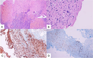 The pathological specimen on hematoxylin-eosin staining showed cellular atypia, hemorrhage, necrosis, and elevated mitotic count (panels A and B). The immunohistochemical study was positive for S100 and SOX10 (panel C and D).