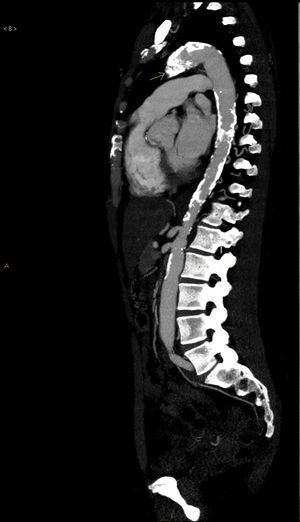 CT angiography with extensive aortic calcification.