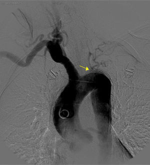 Occlusion of the left subclavian, common carotid, and vertebral arteries.