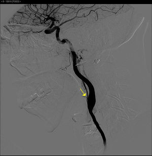 Obstruction of the right external carotid artery.