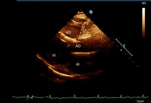 Echocardiographic image of the assessment of epicardial adipose tissue in the right aortoventricular (AoRV) sulcus, with planimetric tracing showing the adipose tissue between the root of the aorta and the right ventricle.