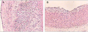 Histological sections of rabbit aortas at the end of the study. Type IV lesion (panel A). Intracellular and extracellular lipid clusters can be seen to a greater extent in the arterial intima in a rabbit belonging to group 2. Type II lesion (panel B). Intracellular lipid clusters can be seen in the arterial intima of a rabbit belonging to group 4. Haematoxylin-eosin staining, 50×.