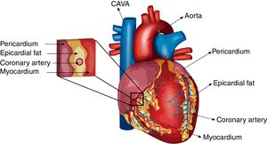 Epicardial adipose tissue (EAT) localization in the heart. EAT is defined as the fat located between the myocardium and visceral pericardium and is anatomically and functionally contiguous to the myocardium.
