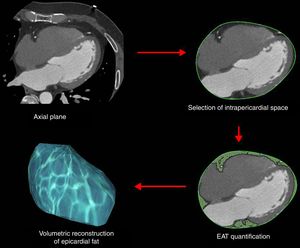 Process of EAT quantification by cardiac computed tomography (CT).