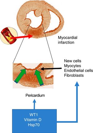 Acute myocardial infarction. The top of the figure shows an occlusion of the coronary artery, which triggers the development of an area of acute myocardial infarction. The enlarged image in the middle shows that this event gives rise to a necrotic area, which promotes the activation of cells with the ability to regenerate. The bottom of the figure shows the cells that invade the infarcted ventricular wall from the pericardium. These cells, together with those with the ability to regenerate, could be positively modulated by WT1, vitamin D levels and Hsp70.