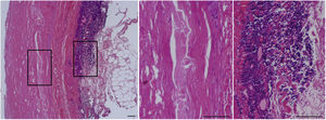 Histopathological characteristics of an abdominal aortic aneurysm (AAA). Haematoxylin–eosin stain of the abdominal aorta of a patient with an AAA. The framed area is shown on the right at a higher magnification. The central panel shows the absence of cellularity (VSMC) in the middle layer of the vascular wall of these patients. Significant immunoinflammatory infiltrate characteristic of the adventitia of an AAA can be seen in the panel on the right. Bars: 150μm.