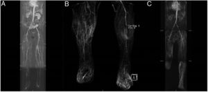 (A) August 2014: significant involvement of the femoral surface and tibial-peroneal territory of the RLL. (B) November 2015: RLL with permeable popliteal artery and complete occlusion of the tibial-peroneal trunk and anterior tibial artery; LLL with occlusion of the superficial femoral artery in its proximal and medial part, with distal reinjection. Popliteal artery permeable throughout its length. Proximal occlusion of the anterior and posterior tibial artery. Occlusion of the proximal third of the peroneal artery and permeability of the posterior tibial artery. (C) February 2016: LLL with severe atheromatous lesions producing critical stenosis in the origin of the common and right external iliac artery. Complete occlusion of the superficial femoral artery in the middle third of the thigh. RLL: right lower limb; LLL: left lower limb. gr1.