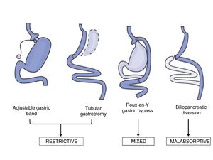 Types of bariatric surgical techniques. Adapted from Pories WJ. Bariatric surgery: Risks and rewards. J Clin Endocrinol Metab. 2008;93:S89-96.