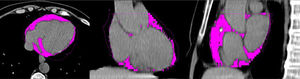 Computed axial tomography. The magenta colour shows the epicardial adipose tissue. Personal archive image.