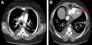 (A) Presence of PE in the right upper lobe (red asterisk). (B) Presence of LV thrombus (red arrow).