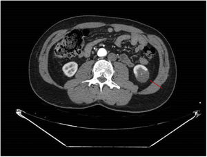 AngioCT revealing an image of a wedge-shaped renal perfusion defect suggestive of left lower pole renal infarction.