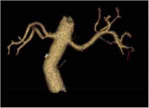 Three-dimensional reconstruction of the abdominal aorta, renal arteries, and segmental branches. The arrow points to one of the segmental branches for the lower pole with marked decrease in vascular calibre.