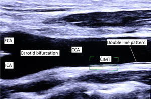 Longitudinal section of CCA and carotid bifurcation. CIMT is defined as a double-line pattern visualized by ultrasonography on both walls of the common carotid artery (CCA). It is formed by lumen-intima and media-adventitia interfaces. CCA, common carotid artery; ECA, external carotid artery; ICA, internal carotid artery; CIMT, carotid intima-media thickness.