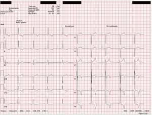 Electrocardiogram on arrival at the Emergency Department. Positive Sokolow-Lyon criteria and deep negative T waves suggestive of ventricular hypertrophy can be seen.