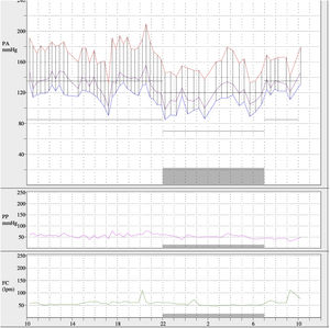 Ambulatory blood pressure monitoring prior to angioplasty. Mean 24h values of 168/113mmHg, daytime mean of 174/119mmHg and nighttime mean of 152/101mmHg were detected.