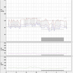 Ambulatory blood pressure monitoring after angioplasty. Mean 24h blood pressure values were 121/84mmHg, daytime mean of 123/87mmHg and nighttime mean of 117/74mmHg.