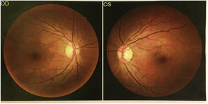Fundus picture. Source: Ophthalmology Technical Unit: Ophthalmology Technical Unit. Clinical History AS400. HECAM.