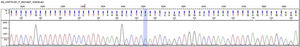 Lipoprotein lipase deficiency, electropherogram: molecular study by next generation sequencing of LPL, APOA5, APOC2, GPIHBP1 and LMF-1 genes. The analysis identified a homozygous mutation in the LPL gene (lipoprotein lipase, OMIM* 609708): c.547G>A (pAsp183Asn) [dbSNPrs118204064]. Source: Mendelics Analise Genomica S, Sao Paulo, Brazil.