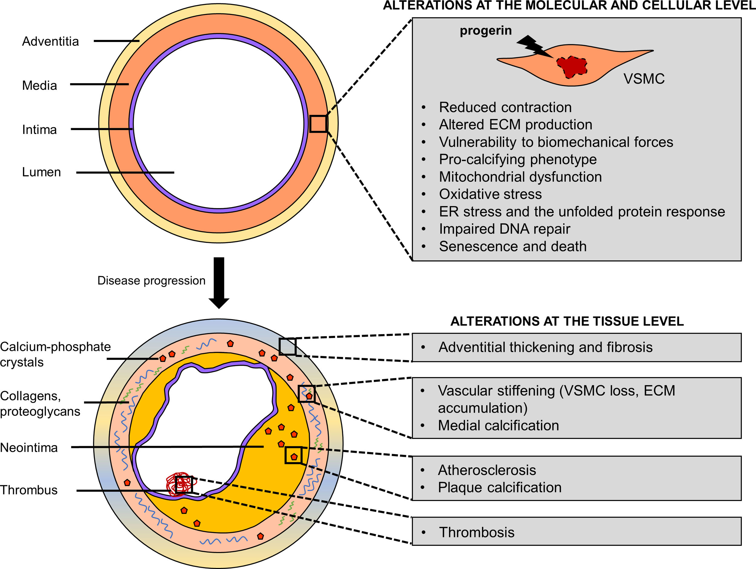 Vascular smooth muscle cell aging: Insights from Hutchinson-Gilford ...