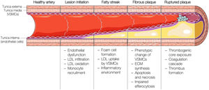 Schematic representation of the different stages of atherosclerotic plaque formation. VSMCs: vascular smooth muscle cells; LDL: low-density lipoprotein; ECM: extracellular matrix. This figure was partly generated using Servier Medical Art, provided by Servier, licensed under a Creative Commons Attribution 3.0 unported license.