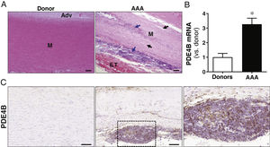 PDE4B expression is increased in human AAA. (A) Representative images of haematoxylin-eosin staining of abdominal aortic samples from healthy donors (Donor) and AAA patients (AAA) showing the disorganisation of the vascular wall in this disease characterised by significant inflammatory infiltrate (blue arrows) and loss of VSMC content (black arrows). The position of the media (M), adventitia (Adv), and intraluminal thrombus (ILT) detected in the aneurysmal lesion is indicated (Bars: 100 μm). (B) Quantification of PDE4B mRNA level in abdominal aorta from donors (n = 15) and AAA patients (n = 27). Results are shown as mean ± SEM. *p < .001 vs. donors. (C) Immunohistochemical analysis for PDE4B in these samples. The magnified region corresponding to the inflammatory infiltrate positive for PDE4B is indicated with an inset (Bars: 100 μm) (For interpretation of the references to colour in this figure legend, the reader is referred to the web version of this article).