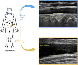 Prepared by the authors. Visualisation of a plaque in the carotid and femoral artery. IMT: intima-media thickness.