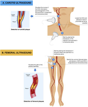 Carotid (A) and femoral (B) ultrasound strategy. CCA: common carotid artery; ECA: external carotid artery; ICA: internal carotid artery; DFA: deep femoral artery; SFA: superficial femoral artery.