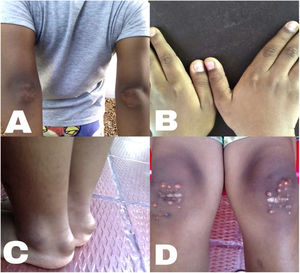 Skin lesions. A) Xanthomas on elbows. B) Xanthomas on knuckles. C) Xanthomas in the rearfoot, at the level of the bilateral Achilles tendon. D) Xanthomas on both knees.