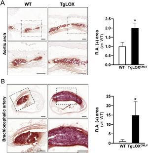 LOX overexpression exacerbated calcification of the atherosclerotic lesions. (A–B) Representative images of Alizarin Red (A.R.) staining and its quantification in sections of atherosclerotic lesions of the aortic arch (A) and of the brachiocephalic artery (B) of WT mice (white bars) and TgLOXVSMV (lack bars) transduced with AAV-PCSK9D374Y and fed an atherogenic diet. The lower panels correspond to the magnification of the areas indicated in the upper panels. Bars: 100 μm. The results are expressed as the mean ± SME (n = 7-9). *p < 0.05 vs. WT transduced with PCSK9D374Y.