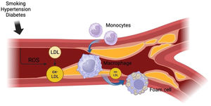 Process of atherosclerosis. This figure provides a summary of the process of atherosclerosis. In its initial stages, various risk factors responsible for atherosclerosis cause direct insult to the arterial endothelium. Such factors include smoking, hypertension, and diabetes which cause endothelial damage by introducing free radicals into the bloodstream. Free radicals are responsible for imposing high-pressure forces on the arterial walls, altering cell metabolism in the endothelium.6 The damaged endothelium subsequently provides the prime environment for high levels of circulating LDL to accumulate in the walls of the arteries and then be oxidized into lipids which initiates a chronic inflammatory response in the walls of the intima.7 Monocytes then appear at the site of the inflammatory response and differentiate into macrophages, which become filled with fat from phagocytosing the newly oxidized lipids to become foam cells.8,9 Diagram created with BioRender.com.