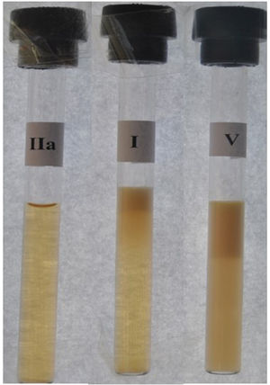 Serum phenotypes after refrigeration. In cases of MCS, refrigerated serum may appear with a milky supernatant (CM) and translucent infranatant or Fredrickson phenotype I, or as a milky supernatant (CM) and turbid infranatant (VLDL) or Fredrickson phenotype V (right). In MCS, only phenotype V (right) is found. This contrasts with pure hypercholesterolemia or phenotype IIa (left).