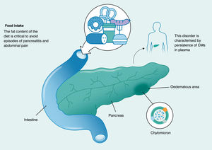 Chylomicronaemia in the pathogenesis of pancreatitis.
