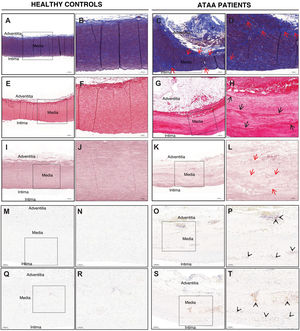 Cross-sectional histological sections of the ascending aorta wall from control subjects and from the dilated ascending aorta wall of patients with ATAA. A–D. Representative areas of sections stained with Masson’s trichrome are shown, where smooth muscle cells and fibrin are shown in red, while collagen is stained blue. Areas with loss of smooth muscle cell nuclei are indicated with red arrows. B and D show that the intima is significantly thicker in the ascending aorta wall of control subjects. E–H. Representative images of sections stained with Picrosirius red showing increased collagen deposition in the media and adventitia of the aortas of patients. I–L. Sections stained with orcein. Note the fragmentation observed in patients with ATAA (red arrows). M–T. Representative images of immunohistochemistry using the CD3 marker to identify T lymphocytes (M–P) and the CD68 marker to identify macrophages (Q–T). Areas where marker-positive cells are found are indicated by arrowheads. ATAA, n = 6; and healthy controls, n = 4. Bar: 500 µm (A, E, I, C, G, K); 200 µm (B, F, J, D, H, L, M, O, Q, S); and 100 µm (N, P, R, T).