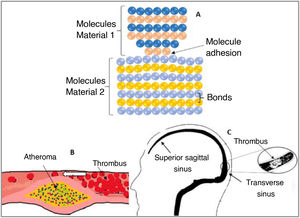 A) Molecular interaction system: this bond of molecules adheres based on the distances between their adhesion bonds. As the distance decreases, the orange molecules bond to the blue molecules to form a new set of molecules. Source: image based on Israelachvili.2 B) Atheroma obstructing the artery, decreasing blood flow, and causing a thrombus. C) Sagittal projection showing the absence of filling of the superior sagittal sinus (SSS) and transverse sinus (ST) along its entire length corresponding to CVT (arrows). Source: image based on Guenther and Arauz.14