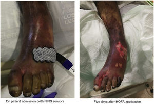 Purpura fulminans lesions. On patient admission (with NIRS sensor) Five days after HOFA application. Source: Images taken by the researchers themselves.