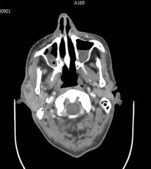 CT-scan of the neck showing nodular hypodense lesion in right parotid gland, with fine peripheral enhancement compatible with abscess.