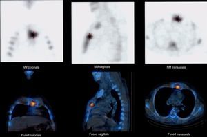 Thoracic-focused Tc-99 bone gammagram and low dose PET/CT showing tracer uptake compatible with sternal osteomyelitis.