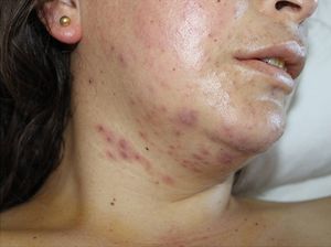 Polymorphic rash with papules, vesicles and erythematous nodules.