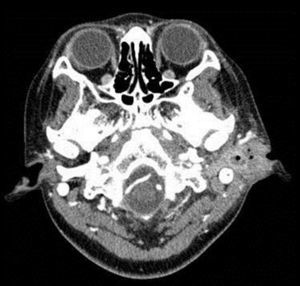 Head and neck CT. Left parotid abscess.