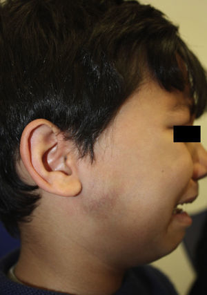 Ipsilateral preauricular swelling.