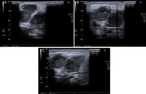 Ultrasound of the right laterocervical region showing multiple adenopathies at the following sites: (A) Intraparotid of up to 24mm. (B) Jugulodigastric of up to 19mm. (C) Submandibular of up to 23mm.