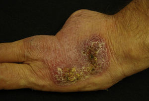 Indurated erythematous plaque with yellowish eschars on the back of the left hand.
