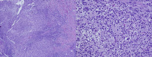 Histologically, a chronic, granulomatous, inflammatory reaction is observed.