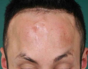 Right frontal region with fluctuating swelling.