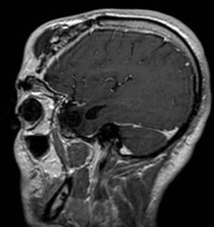 Brain MRI with gadolinium, sagittal plane.