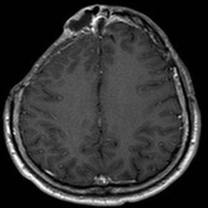 Brain MRI with gadolinium, coronal plane (October 2014).