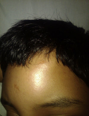 Patient on admission with soft tissue oedema in the left frontal region.