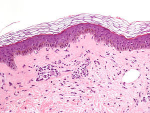 The biopsy showed a slight vacuolar degeneration of the basal layer and a slight superficial lymphohistiocytic perivascular inflammatory infiltrate.