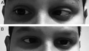 The patient presents an abduction limitation of the right eye in the right lateral gaze (A) and abduction of the left eye in the left lateral gaze (B).