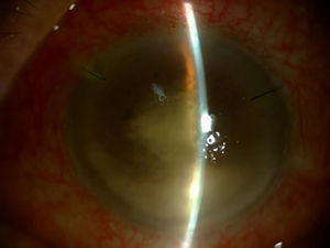 Appearance after the initial vitrectomy. Infiltrate in the anterior chamber and hypopyon relapse.